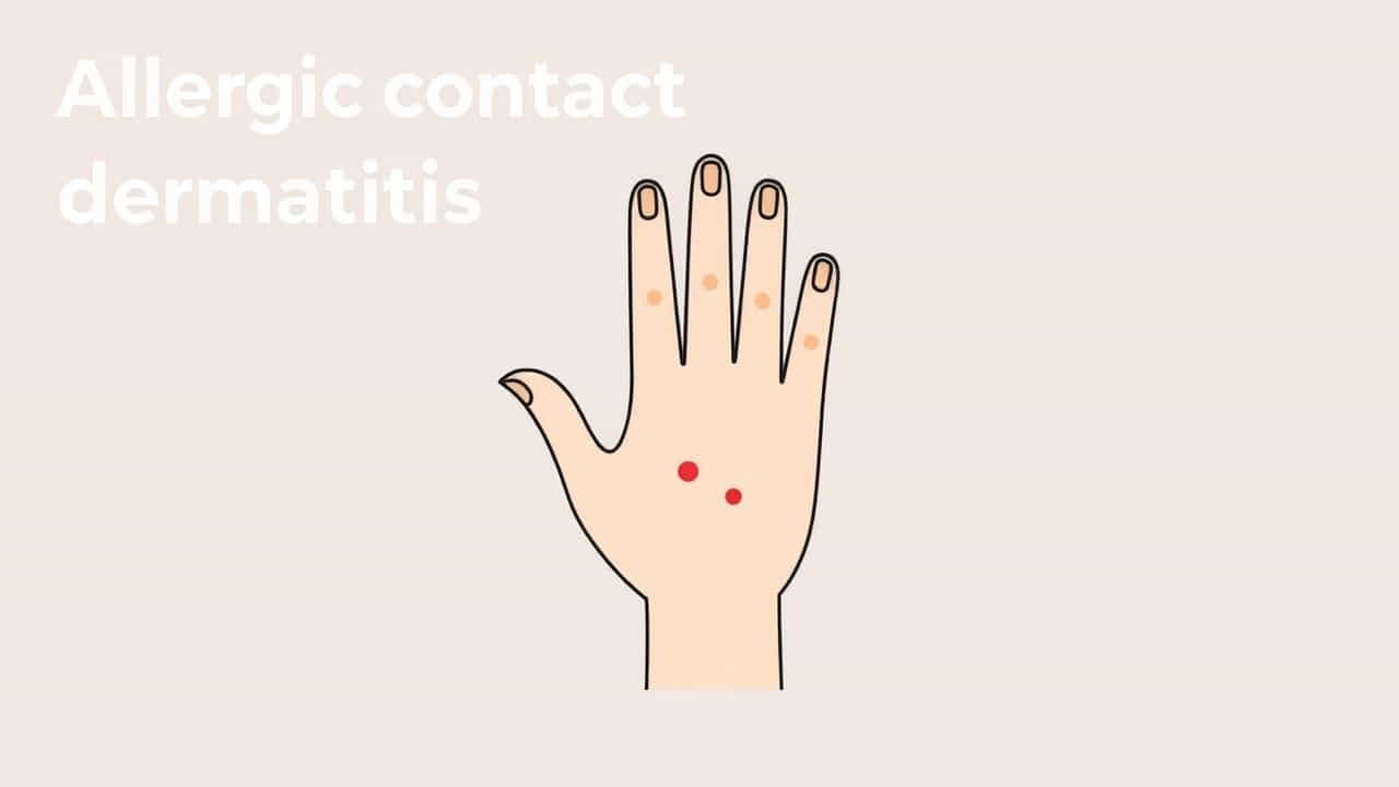 What Is Allergic Contact Dermatitis