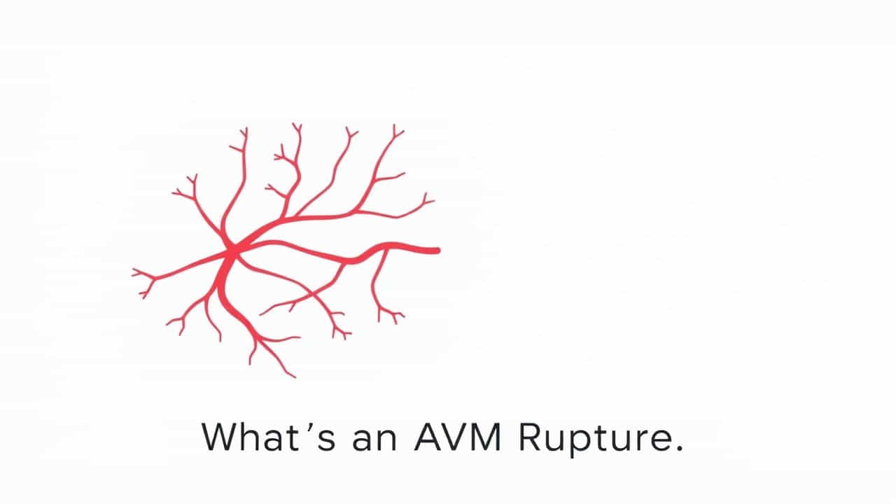 What Is An Avm Rupture